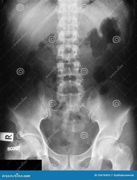 Scout Film Of Ivp Intravenous Pyelogram Stock Image Image Of