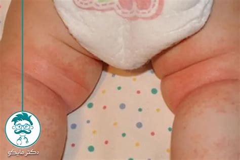 سریعترین راه درمان عرق سوز شدن ران زیربغل گردن انگشتان پا