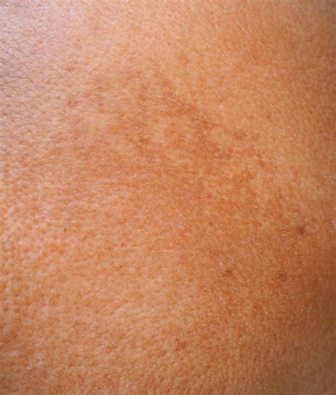 Types Causes And Symptoms Of Skin Discoloration General Center My Xxx