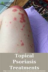 Topical Treatment For Psoriasis Pictures