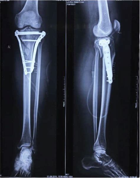 A 43 Year Old Male With Schatzker Type Vi Tibial Plateau Fracture With