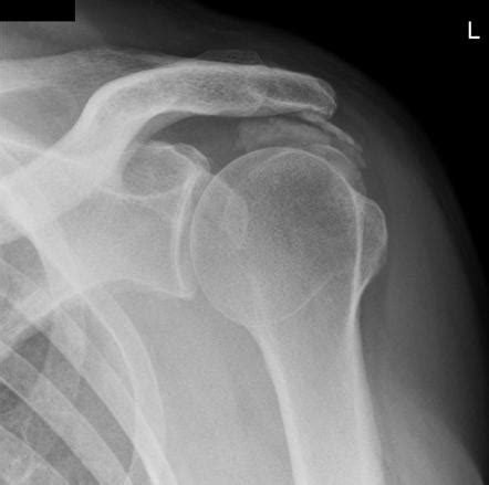 Subacromial Subdeltoid Bursitis Radiology Reference Article