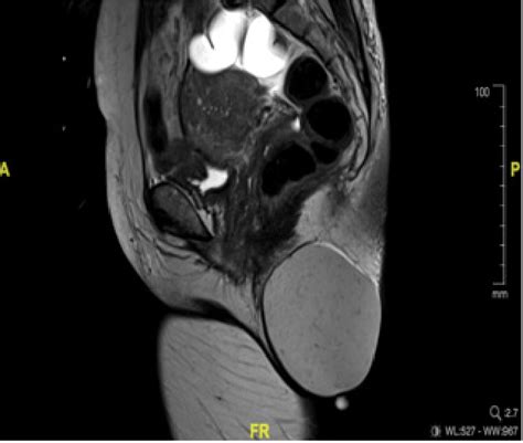 Figure 2 From Case Series Giant Epidermal Inclusion Cyst Of Gluteal