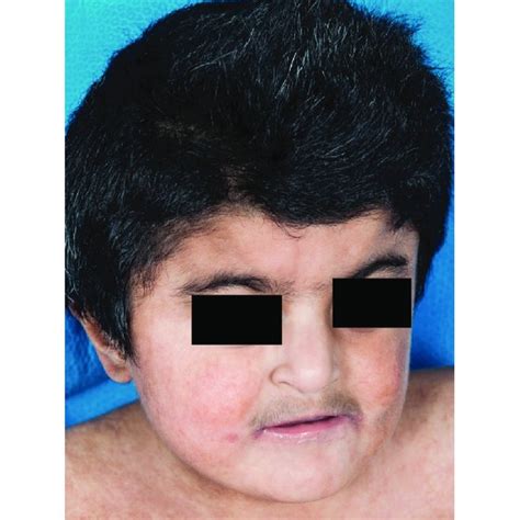 Hair And Skin Pigmentary Dysplasia Along With Hypertrichosis And