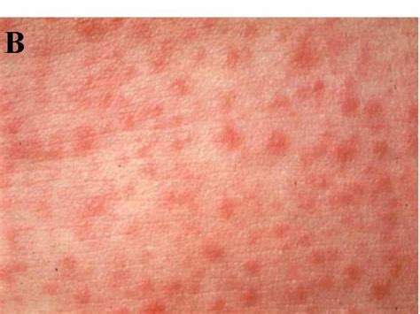 Bacterial Rash Pictures Photos