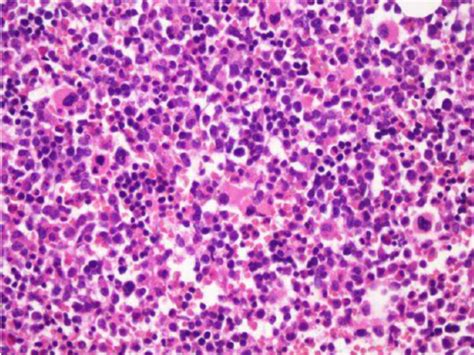 Hypercellular Bone Marrow With 90 Cellularity He X200 Download