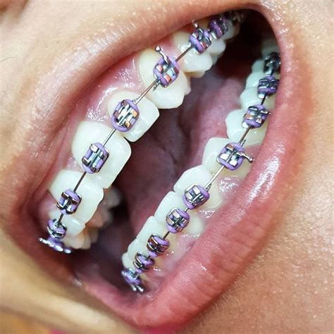 pin de bluesky en aparatić ligas para brackets brackets dentales dientes con brackets