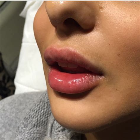 Perfect Lip Fillers Perfect Lips Lip Fillers Lip Fillers Juvederm