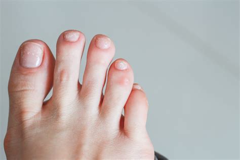 What Are White Spots On Toes Design Talk