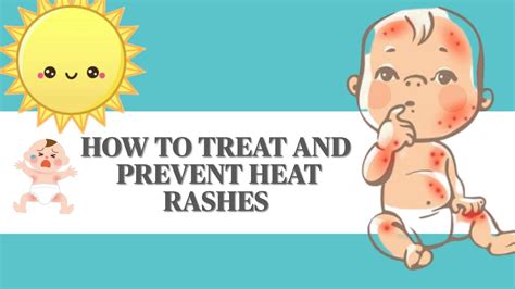 Quick Guide For How To Treat And Prevent Heat Rashes Mom Buzz Youtube