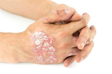 Psoriasis Vulgaris On The Male Hands With Plaque Rash And Patches