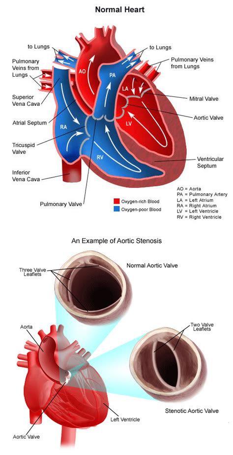 Aortic Stenosis Choc Childrens