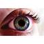 Heterochromia  Value Your Eyes