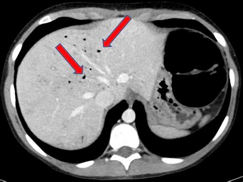 Cureus Hepatic Portal Venous Gas Incidentally Associated With