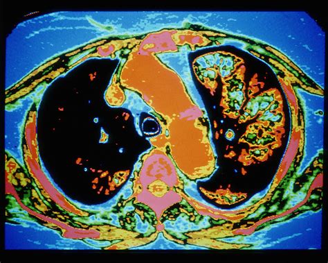 Ct Scan Of A Lung With Emphysema Photograph By Gcascience Photo Library