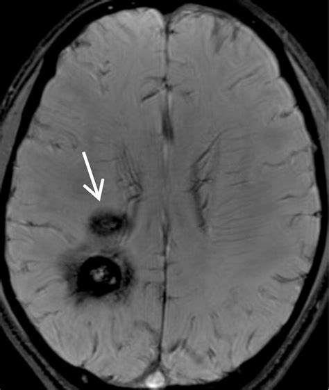 Intracranial Calcifications And Hemorrhages Characterization With