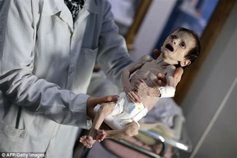 Malnourished Syrian Baby Treated In Rebel Held Kafr Batna Daily Mail