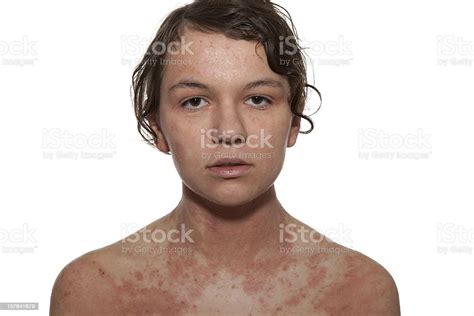 Atopic Dermatitis Stock Photo Download Image Now Atopic Eczema