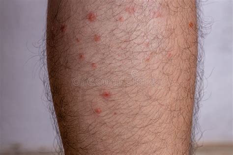 Allergic Reactions To Tick Bites Stock Photo Image Of Arachnida