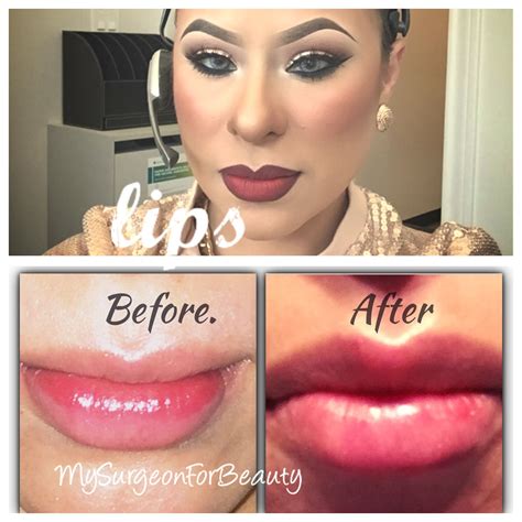 Plump Lips With Juvederm Ultra Lip Plumper Plumping Pearland Tx