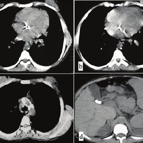 Axial Ct Images Aortic And Mitral Valve Calcification Ab Aortic