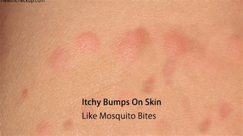Itchy Bumps On Skin Like Mosquito Bites Sea Lice That Nasty Rash You