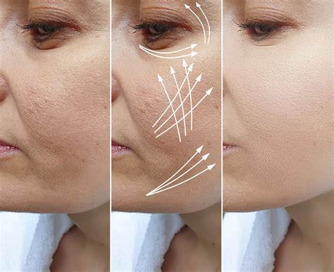 What Is The Best Skin Tightening Treatment