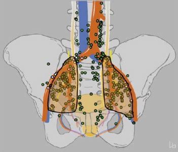 Standardized And Simplified Extended Pelvic Lymph Node Dissection