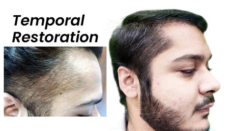 Top 120 Temple Hair Transplant Before After Polarrunningexpeditions
