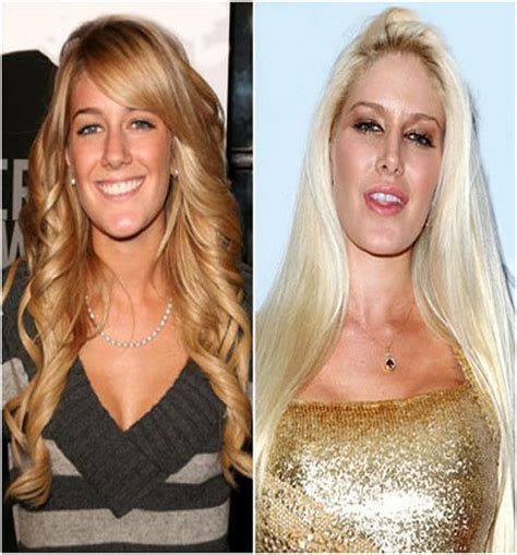 Heidi Montag Before After