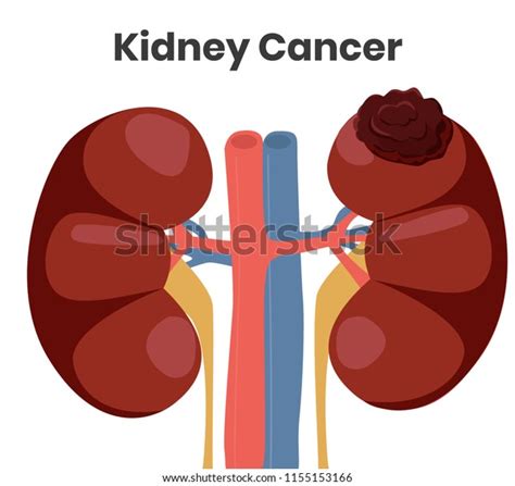 Vector Illustration Kidney Cancer Tumor Affecting Stock Vector Royalty