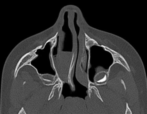 Deviated Septum Ct Scan Images Captions Todays