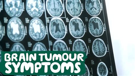 Brain Tumour Symptoms Macmillan Cancer Support Youtube