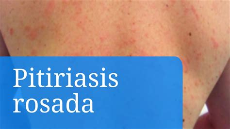 Pitiriasis Rosada Fotos De Los Síntomas Causas Y Tratamiento Youtube