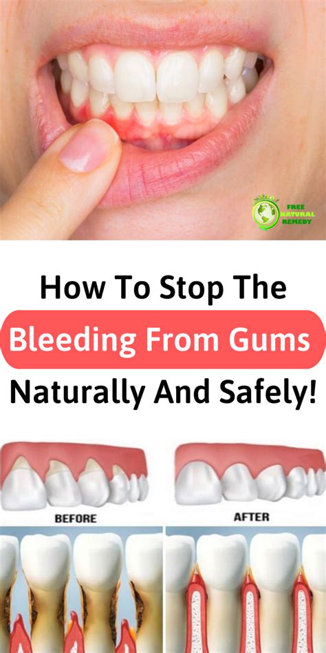 How To Stop Gum Bleeding Immediately Unugtp News