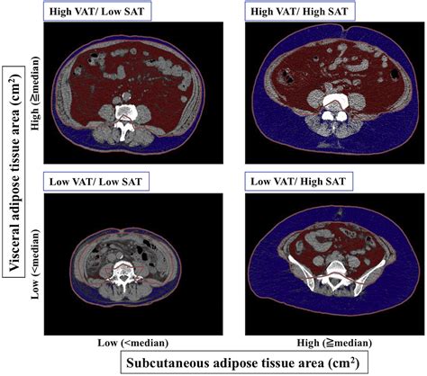 Impact Of Abdominal Fat Distribution Visceral Fat And Subcutaneous