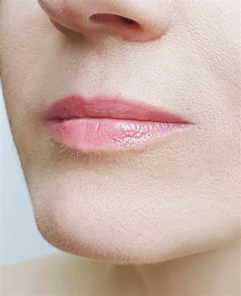 Thin Lips Face Restoration Facial Aesthetics