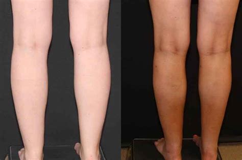 Calf Liposuction Before And After Photos 14 Liposuction Lymphatic Drainage Massage Lymphatic