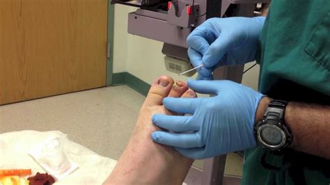 Paronychia Of Toe With Complicated Cellulitis Youtube