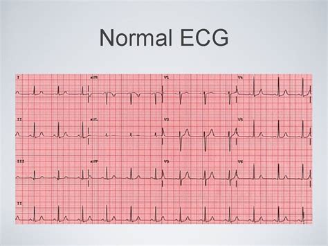 Recognizing Cardiac Arrhythmias Normal Anatomy Normal Ecg Normal