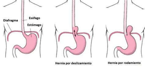 Fisioterapia Cranium Hernia De Hiato Causas Síntomas Y Tratamiento