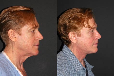male deep plane facelift before and after dr andrew jacono muscles of the face face lift