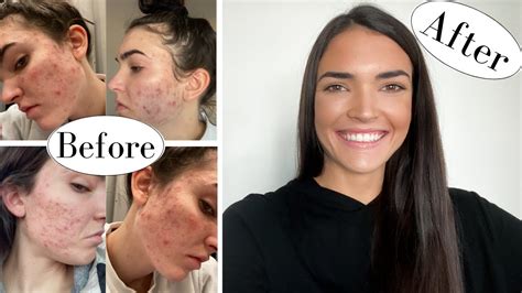 How I Cleared My Acne Naturally Youtube