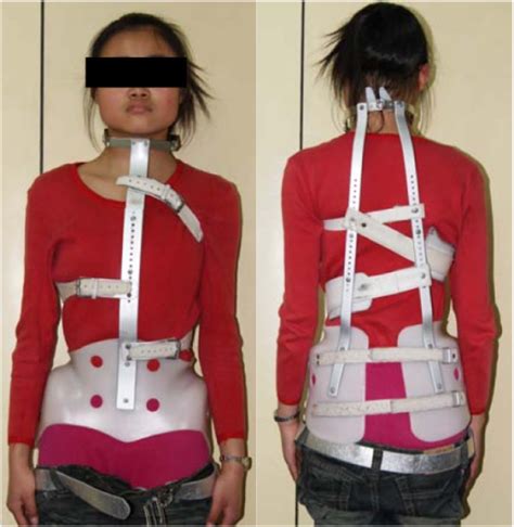 The Same Patient Wearing Milwaukee Brace The Neck Ring