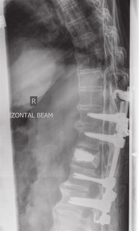 Three Column Spinal Fracture Chance Fracturet6 Fig 4 Spinal