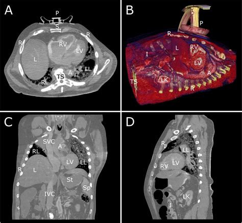 New 3d Ct Scanning Method Shows What Happens During Cpr • Healthcare In