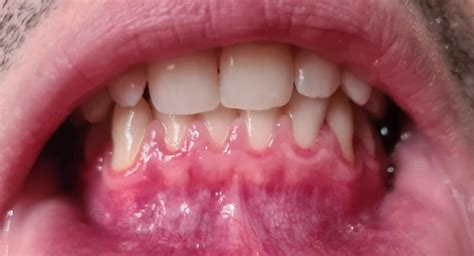 Small White Lump On Gum Extremely Sore Rdentalhygiene