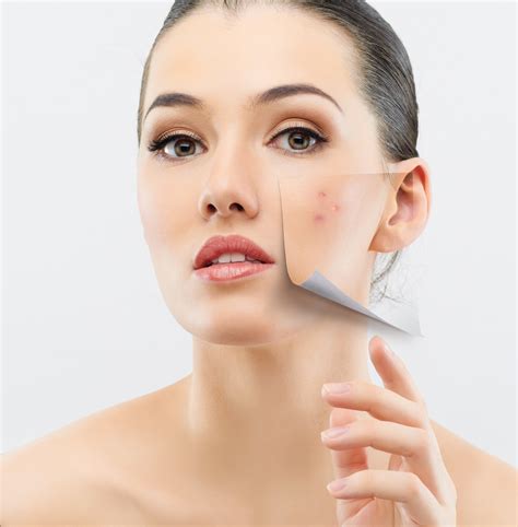 Laser Acne Treatments Laser Skin Clinic Toronto Igbeauty