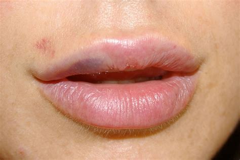 Bruised Lips From Kissing Top Tips To Avoid It Next Time Beezzly