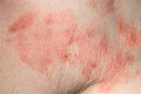 Lyme Disease Skin Rash Puzzles Doctors Leads To Misdiagnoses Daniel